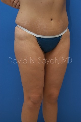Body Lift Before and After | Sayah Institute