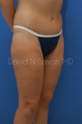 Body Lift Before and After | Sayah Institute