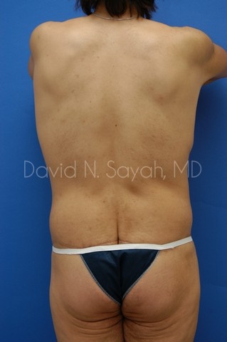 Body Lift Before and After | Sayah Institute