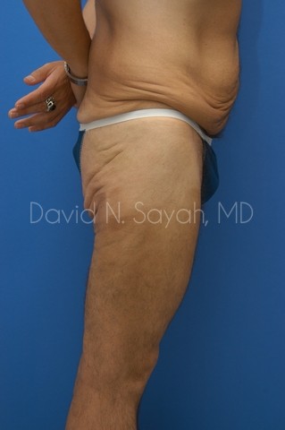 Body Lift Before and After | Sayah Institute