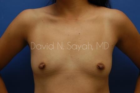 Breast Augmentation Before and After | Sayah Institute