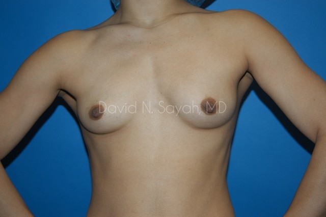 Breast Augmentation Before and After | Sayah Institute