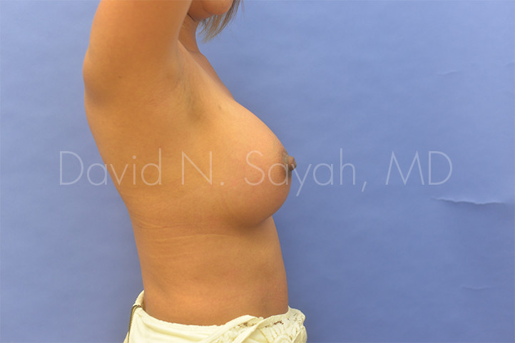 Breast Augmentation Before and After | Sayah Institute