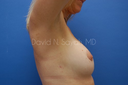 Breast Implant Exchange Before and After | Sayah Institute