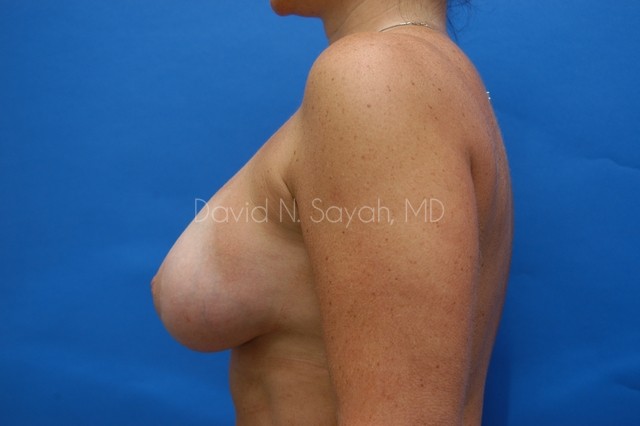 Breast Implant Revision Before and After | Sayah Institute