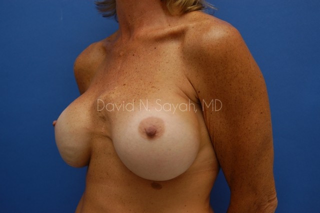 Breast Implant Revision Before and After | Sayah Institute