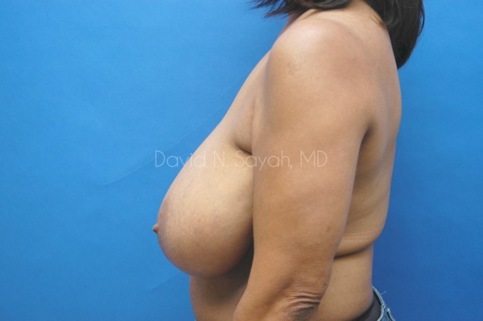 Breast Lift Before and After | Sayah Institute