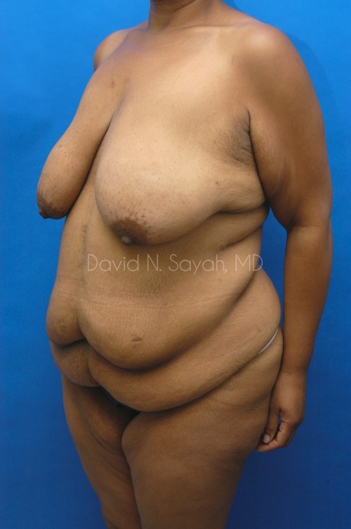Breast Lift Before and After | Sayah Institute