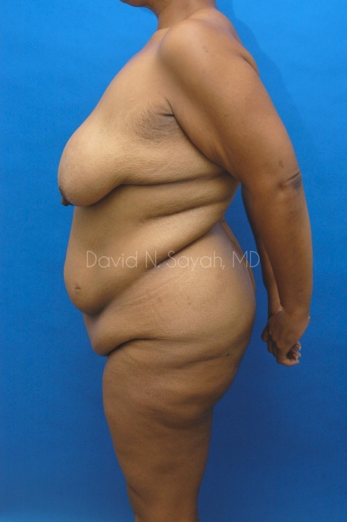 Breast Lift Before and After | Sayah Institute