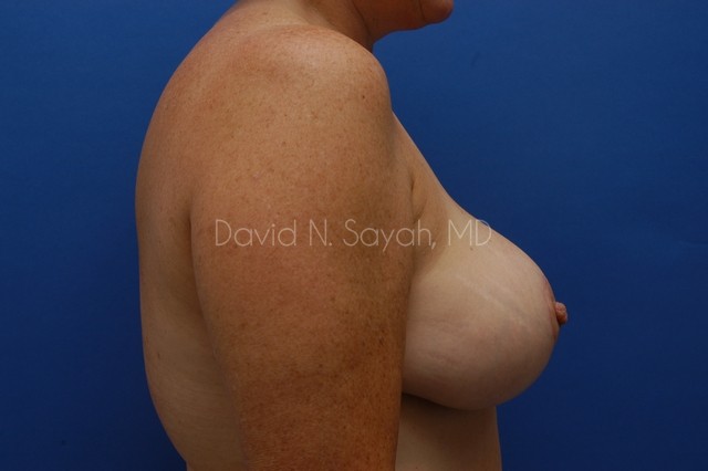 Breast Lift Before and After | Sayah Institute