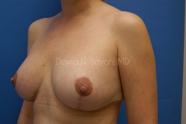 Breast Lift Before and After | Sayah Institute