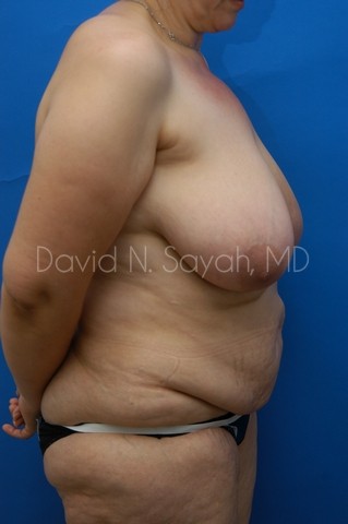 Breast Lift Before and After | Sayah Institute