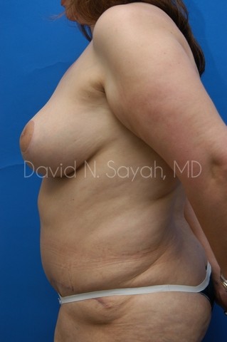 Breast Lift Before and After | Sayah Institute