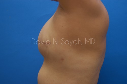 Breast Reconstruction Before and After | Sayah Institute