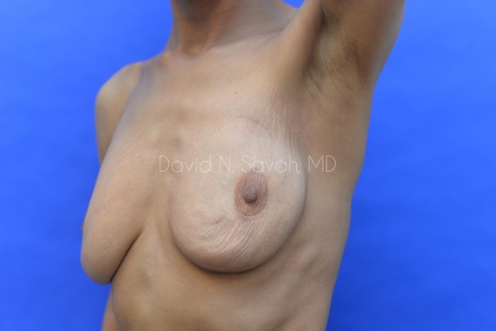 Breast Reduction Before and After | Sayah Institute