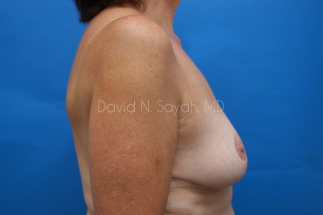 Breast Reduction Before and After | Sayah Institute