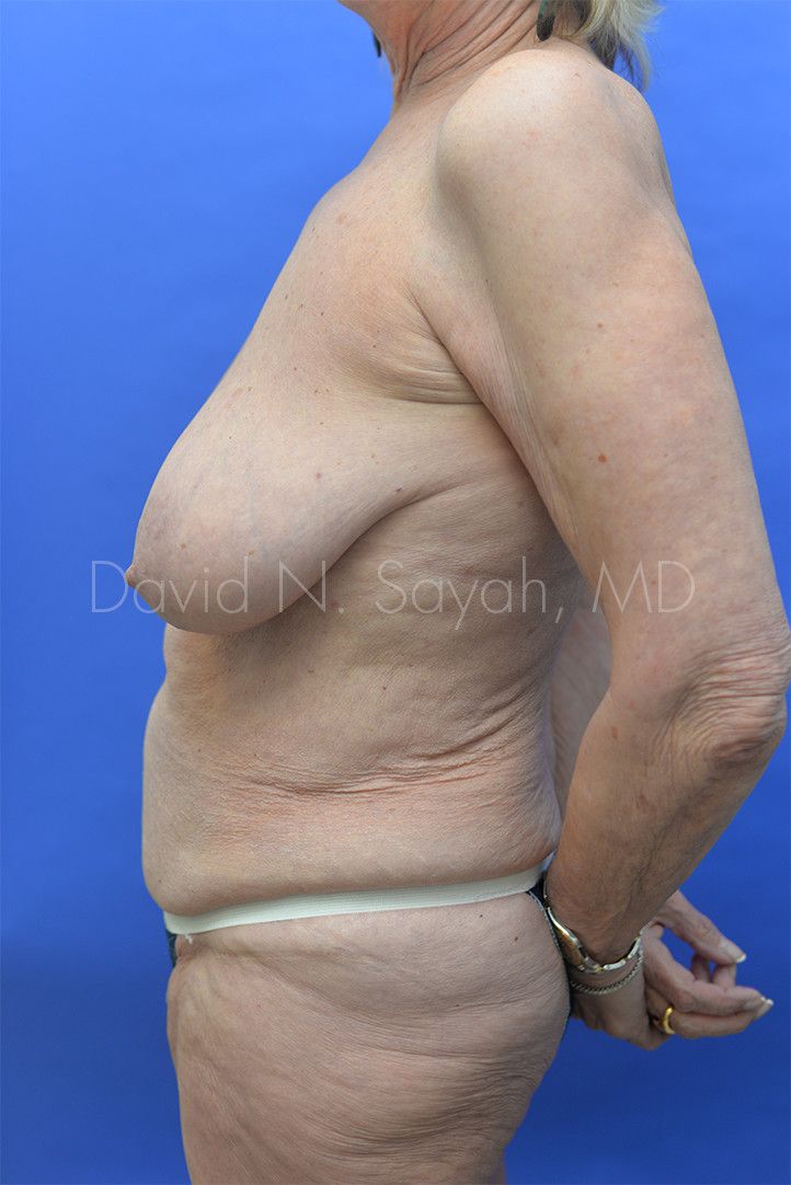 Breast Reduction Before and After | Sayah Institute