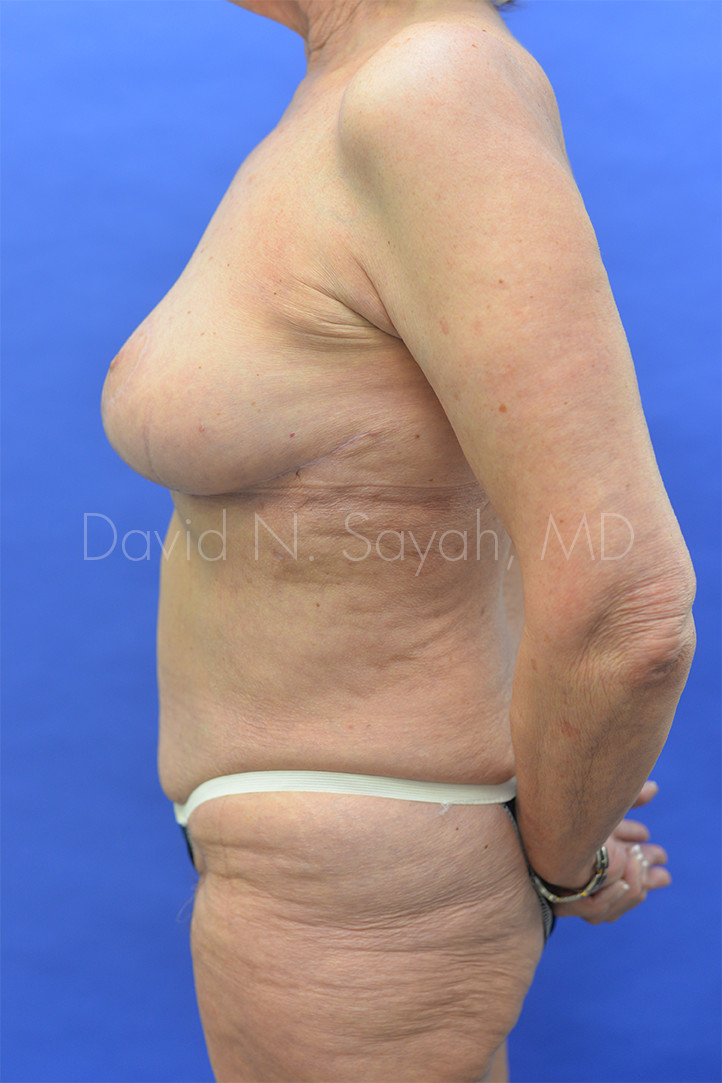 Breast Reduction Before and After | Sayah Institute