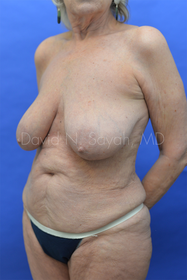 Breast Reduction Before and After | Sayah Institute