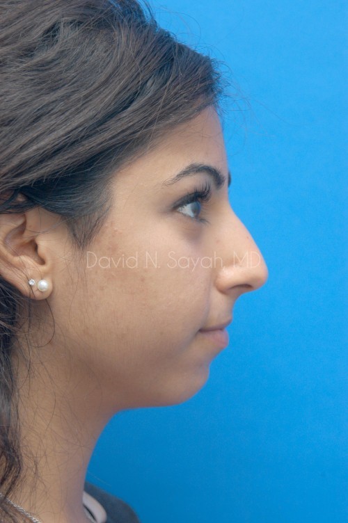 Chin Implant Before and After | Sayah Institute