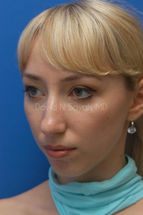 Chin Implant Before and After | Sayah Institute