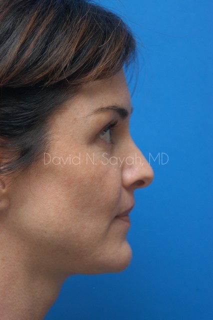 Chin Implant Before and After | Sayah Institute