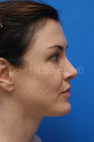 Chin Implant Before and After | Sayah Institute