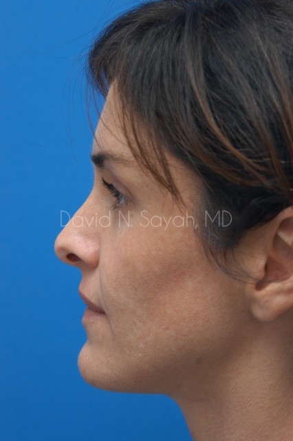 Chin Implant Before and After | Sayah Institute
