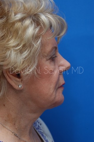 Chin Implant Before and After | Sayah Institute