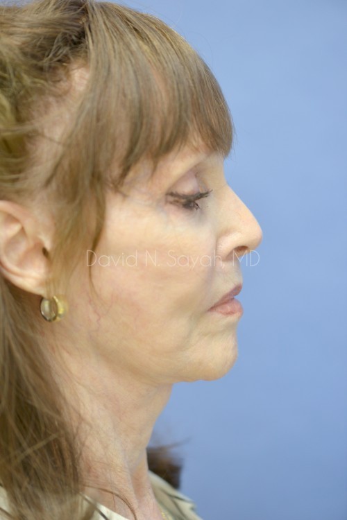 Co2 Laser Before and After | Sayah Institute