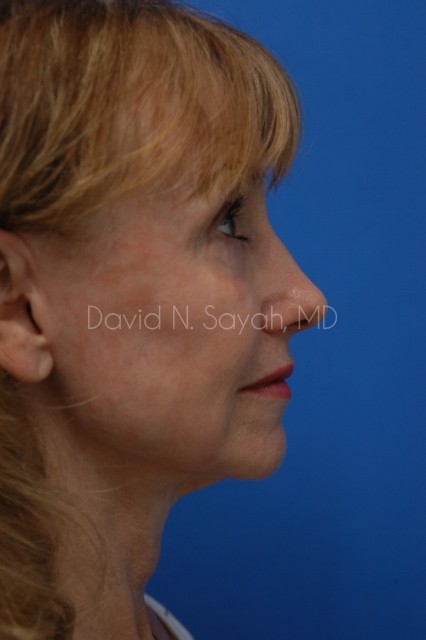 Co2 Laser Before and After | Sayah Institute