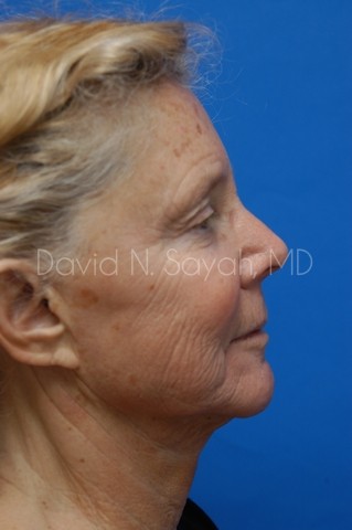 Co2 Laser Before and After | Sayah Institute