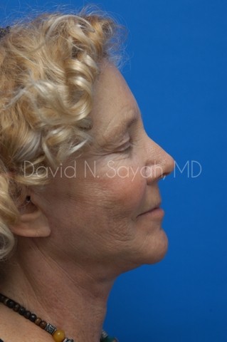 Co2 Laser Before and After | Sayah Institute