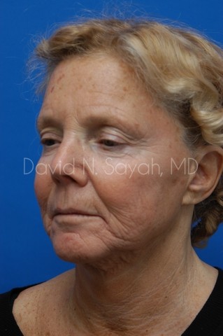 Co2 Laser Before and After | Sayah Institute