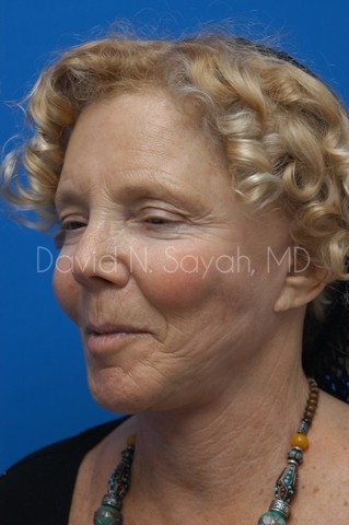 Co2 Laser Before and After | Sayah Institute