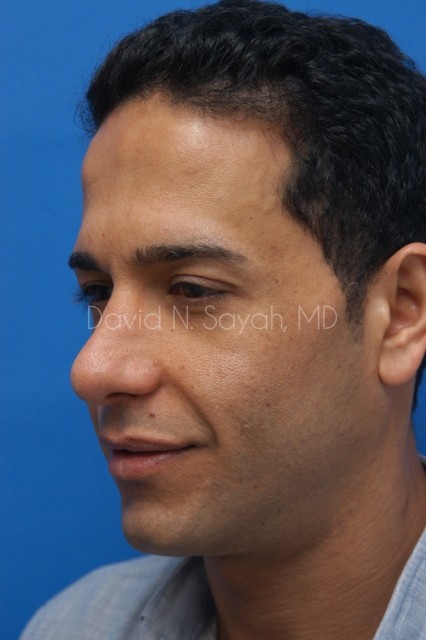 Eyelid Surgery Before and After | Sayah Institute