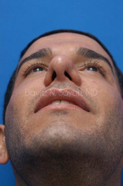 Eyelid Surgery Before and After | Sayah Institute