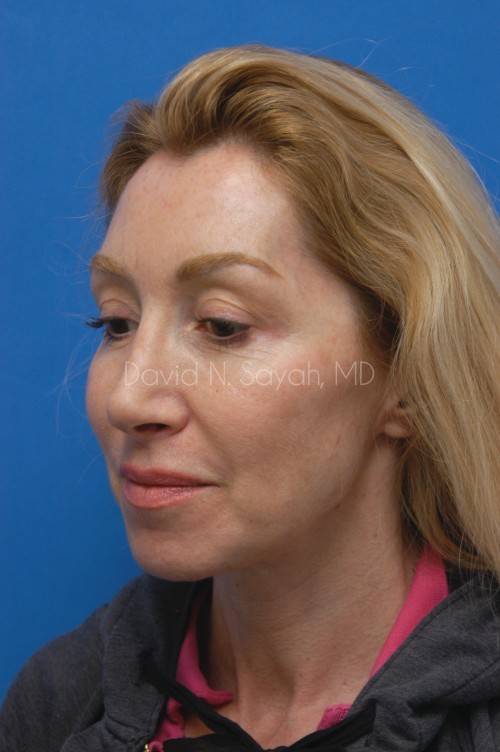 Eyelid Surgery Before and After | Sayah Institute