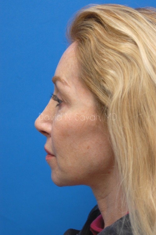 Eyelid Surgery Before and After | Sayah Institute