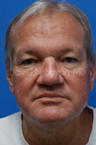Eyelid Surgery Before and After | Sayah Institute