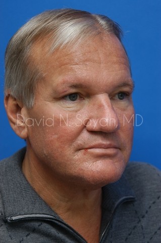 Eyelid Surgery Before and After | Sayah Institute
