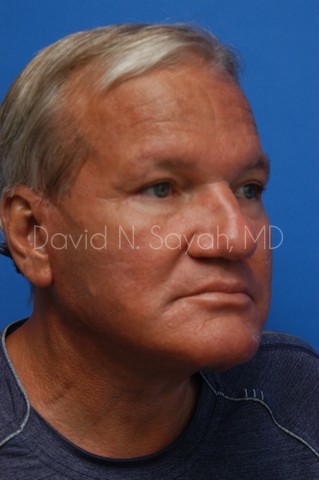 Eyelid Surgery Before and After | Sayah Institute