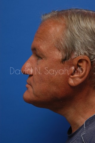 Eyelid Surgery Before and After | Sayah Institute