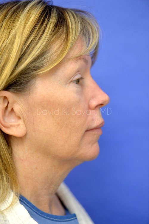 Facelift Before and After | Sayah Institute
