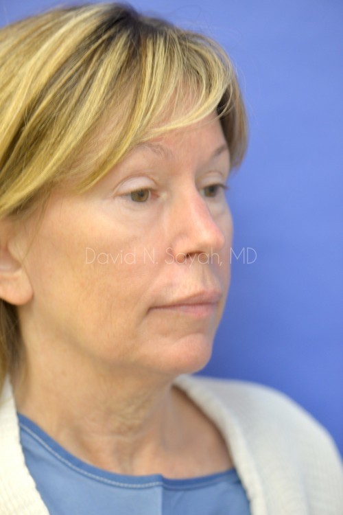 Facelift Before and After | Sayah Institute