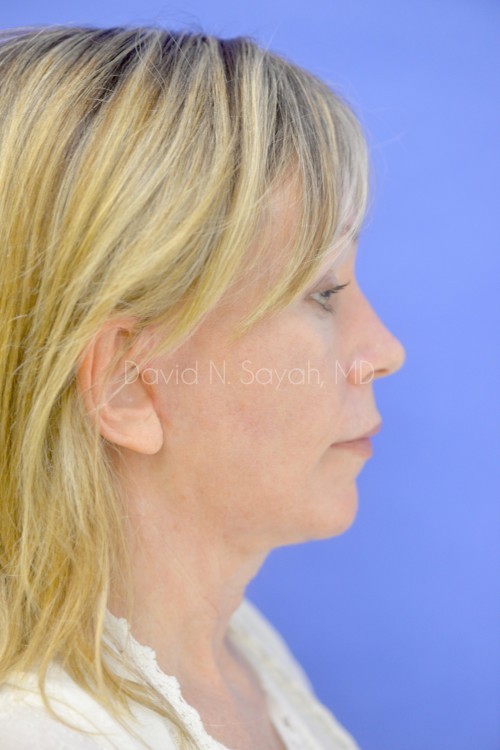 Facelift Before and After | Sayah Institute