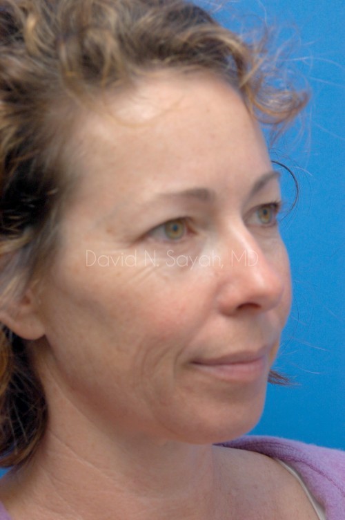 Facelift Before and After | Sayah Institute