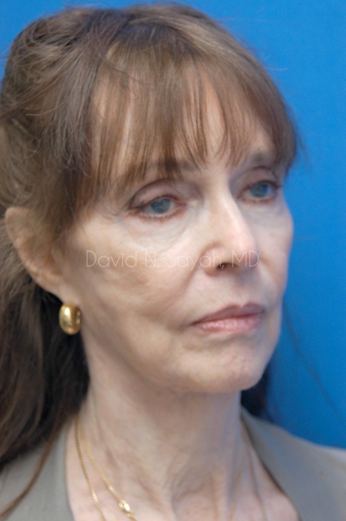 Facelift Before and After | Sayah Institute