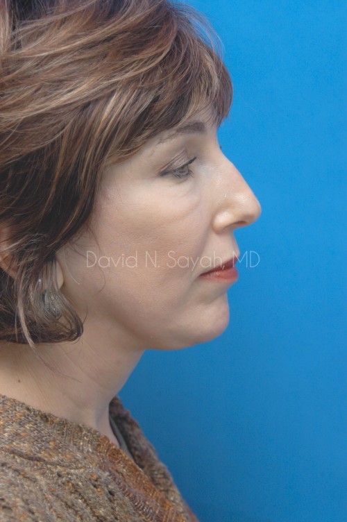 Facelift Before and After | Sayah Institute