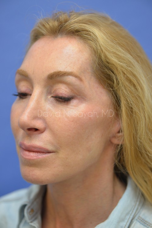 Facelift Before and After | Sayah Institute